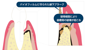 歯周組織の断面のイラスト。歯周ポケットにバイオフィルムに守られた縁下プラークがあり、破骨細胞によって歯槽骨の破壊が起こっている。