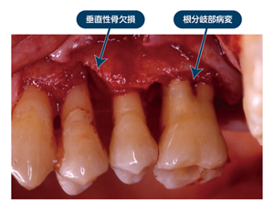 垂直性骨欠損、根分岐部病変の写真