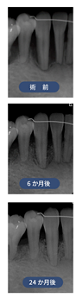術前、6ヶ月後、24ヶ月後のX線写真