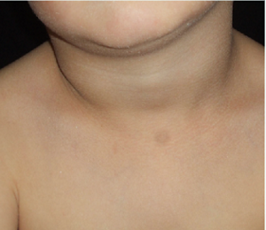 乾燥した皮膚の臨床写真。アトピー性皮膚炎に伴う乾燥肌。