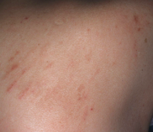 乾燥した皮膚の臨床写真。アトピー性皮膚炎に伴う乾燥肌。