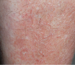 乾燥した皮膚の臨床写真。皮脂欠乏性湿疹。