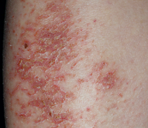 乾燥した皮膚の臨床写真。 皮脂欠乏性湿疹。