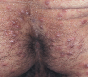 鑑別を要する皮膚疾患の写真。疥癬。