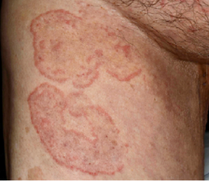 鑑別を要する皮膚疾患の写真。体部白癬。