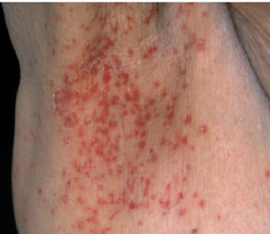 鑑別を要する皮膚疾患の写真。カンジダ性間擦疹。