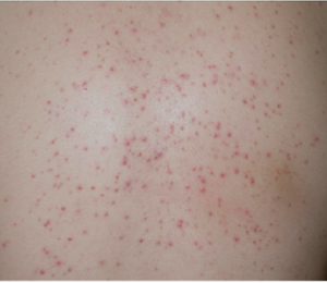 鑑別を要する皮膚疾患の写真。マラセチア毛包炎。