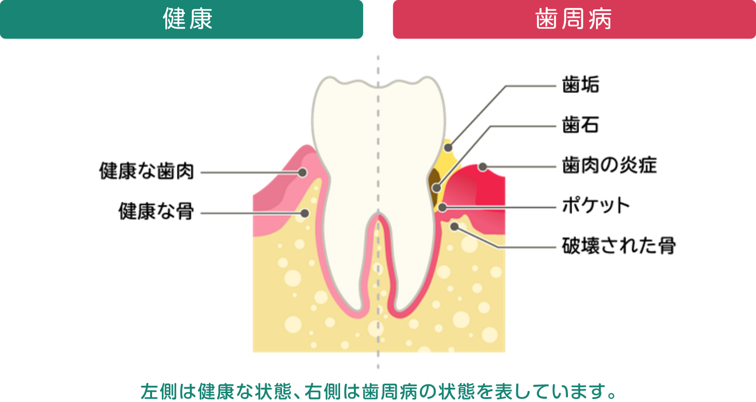 歯周病は全身疾患の悪化も招く！口腔ケアのポイントとは？