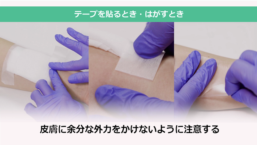 テープテアを予防するためのテープの貼り方 はがし方 花王プロフェッショナル 業務改善ナビ 介護の現場にソリューション