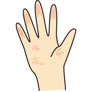 手に傷や手荒れがある状態のイラスト。