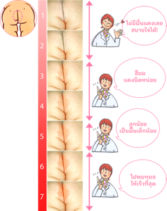 ระดับความแดงบนก้นลูกน้อย