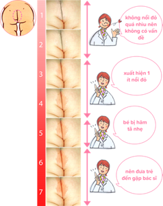 ระดับความแดงบนก้นลูกน้อย