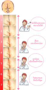 ระดับความแดงบนก้นลูกน้อย