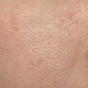 毛穴が開いている肌