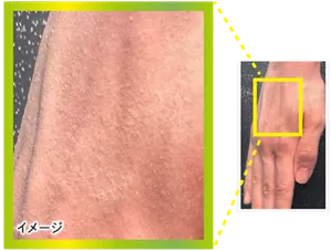 炭酸泡がついた手と、その手の肌の一部を拡大した写真 イメージ