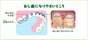 むし歯になりやすいところは歯と歯のすき間、奥歯のみぞ、歯と歯ぐきのさかいめです。