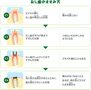 むし歯のすすみ方：C1. エナメル質にむし歯が発生した状態です。それほど痛みは感じません。／C2. むし歯が象牙質まですすんだ状態です。冷たいものがしみるようになります。／C3. むし歯がしんけいにまですすんだ状態です。ズキズキ痛むこともあります。／C4.目に見える部分がほとんどなく、歯の根だけのこった状態です。痛みはなくなることもあるが、根の先にウミがたまる場合もあります。