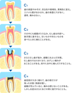 C1：歯の表面やみぞが、灰白色や黄褐色、黒褐色に変化。エナメル質がおかされ、歯の表面に穴があく。通常、痛みはない。／C2：穴の中にも細菌が入り込み、むし歯は内部へ。象牙質に達すると、甘いものや冷たいものを食べたときに痛むことがある。／C3：さらにむし歯が進み、歯髄におよんだ状態。むし歯の穴は大きくなり、はげしい痛みがおこることがある。夜や入浴中に痛んだりすることも。／C4：歯冠部が大きく壊れて、歯の根だけが残った状態（残根状態）。歯髄が死んでいると、痛みは感じないことがある。しかし炎症はさらに顎の骨に進行することも。