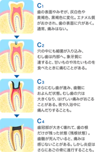 C1：歯の表面やみぞが、灰白色や黄褐色、黒褐色に変化。エナメル質がおかされ、歯の表面に穴があく。通常、痛みはない。／C2：穴の中にも細菌が入り込み、むし歯は内部へ。象牙質に達すると、甘いものや冷たいものを食べたときに痛むことがある。／C3：さらにむし歯が進み、歯髄におよんだ状態。むし歯の穴は大きくなり、はげしい痛みがおこることがある。夜や入浴中に痛んだりすることも。／C4：歯冠部が大きく壊れて、歯の根だけが残った状態（残根状態）。歯髄が死んでいると、痛みは感じないことがある。しかし炎症はさらに顎の骨に進行することも。