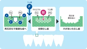 初期むし歯の状態なら、フッ素で再石灰化を促進させ健康な歯に修復できますが、穴があいたむし歯になると元には戻りません。