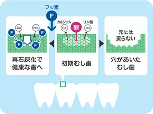 初期むし歯の状態なら、フッ素で再石灰化を促進させ健康な歯に修復できますが、穴があいたむし歯になると元には戻りません。