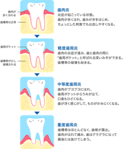 歯肉炎：炎症が起こっている状態。歯肉が赤くはれ、歯みがきをはじめ、ちょっとした刺激でも出血しやすくなる。／軽度歯肉炎：歯肉の炎症が進み、歯と歯肉の間に「歯周ポケット」と呼ばれる深いみぞができる。歯槽骨の破壊も始まる。／中等度歯肉炎：歯肉がブヨブヨにはれ、歯周ポケットからうみが出て、口臭もひどくなる。歯が浮く感じがして、ものがかみにくくなる。／重度歯肉炎：歯槽骨はほとんどなく、歯根が露出。歯肉がはれて痛み、歯はグラグラになって最後には抜けてしまう。