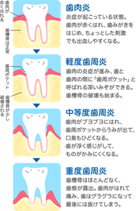 歯肉炎：炎症が起こっている状態。歯肉が赤くはれ、歯みがきをはじめ、ちょっとした刺激でも出血しやすくなる。／軽度歯肉炎：歯肉の炎症が進み、歯と歯肉の間に「歯周ポケット」と呼ばれる深いみぞができる。歯槽骨の破壊も始まる。／中等度歯肉炎：歯肉がブヨブヨにはれ、歯周ポケットからうみが出て、口臭もひどくなる。歯が浮く感じがして、ものがかみにくくなる。／重度歯肉炎：歯槽骨はほとんどなく、歯根が露出。歯肉がはれて痛み、歯はグラグラになって最後には抜けてしまう。