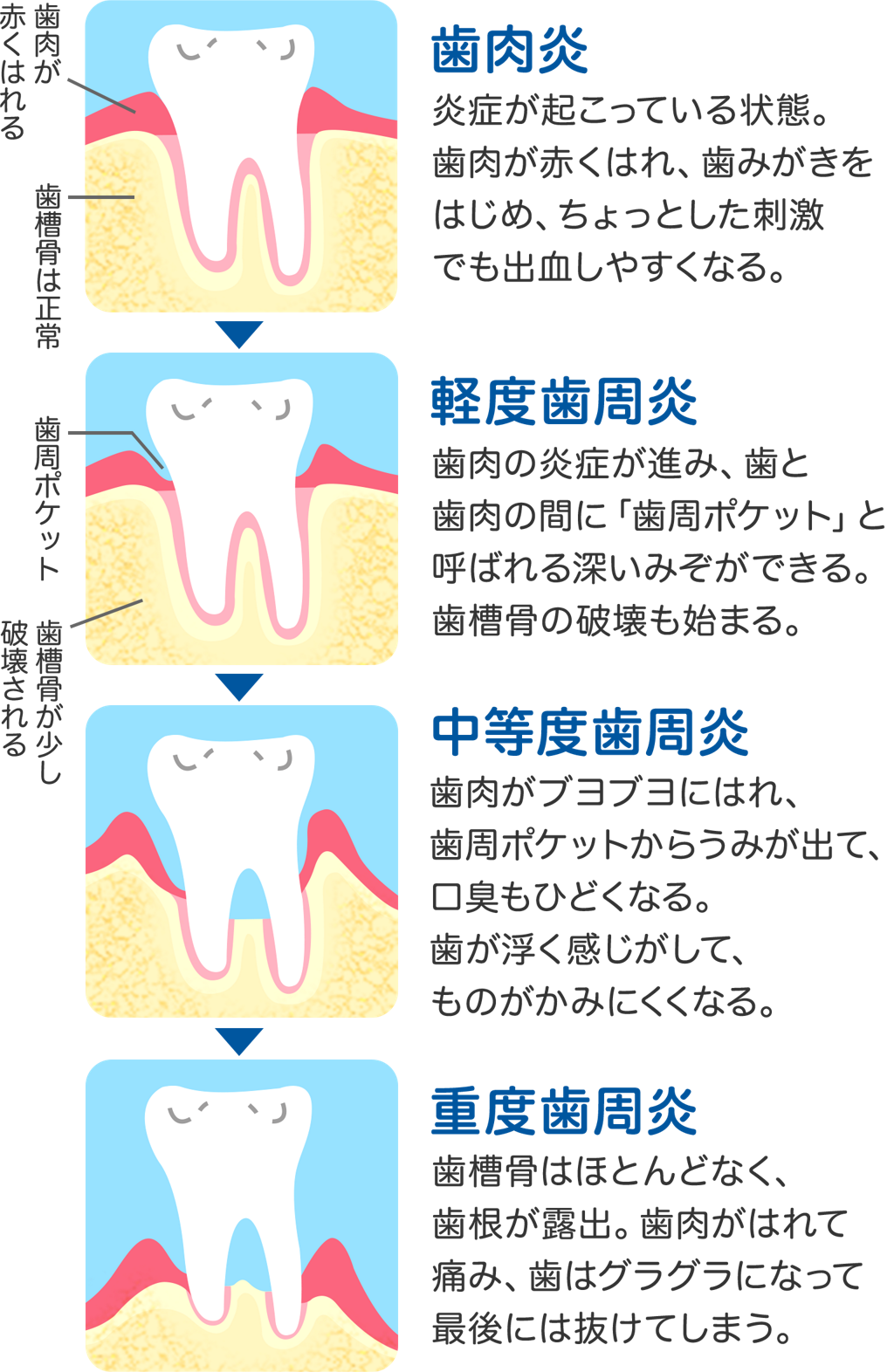 歯肉炎 歯周炎 歯の健康 基本のき オーラルケア情報 クリアクリーン 花王株式会社