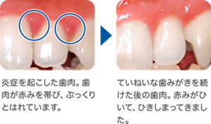 炎症を起こした歯肉。歯肉が赤みを帯び、ぷっくりとはれています。→ていねいな歯みがきを続けた後の歯肉。赤みがひいて、ひきしまってきました。