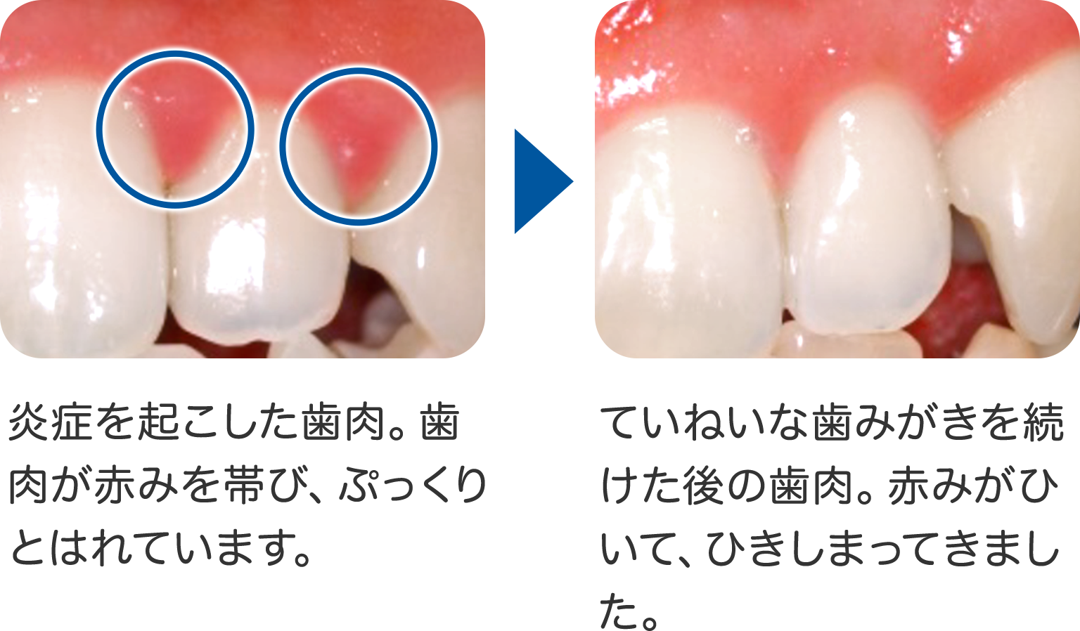 歯肉 炎 と は