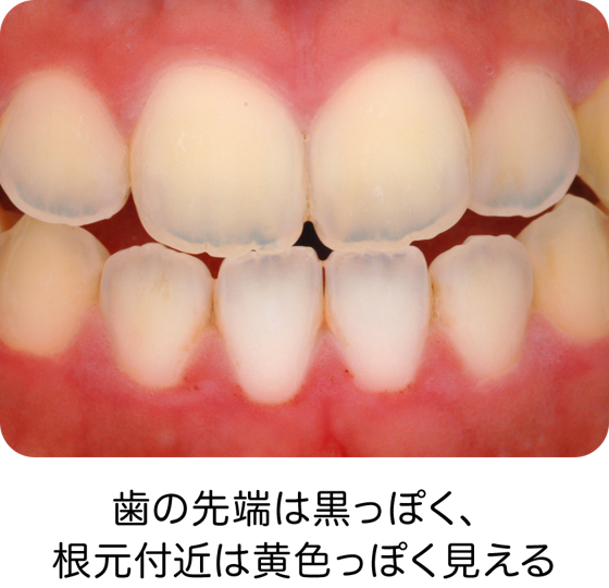 歯の色と着色 歯の健康 基本のき オーラルケア情報 クリアクリーン 花王株式会社