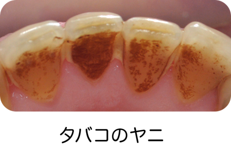 歯の色と着色 歯の健康 基本のき オーラルケア情報 クリアクリーン 花王株式会社