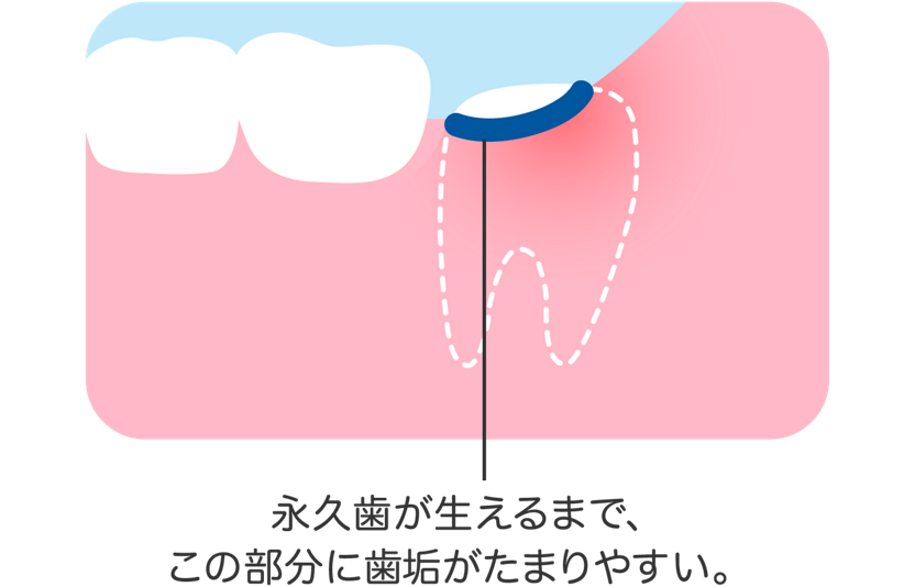 3 むし歯以外の よくあるトラブル 生えかわり期の歯みがきq A 6 12歳 オーラルケア情報 クリアクリーン 花王株式会社