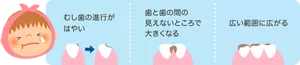 むし歯の進行がはやい／歯と歯の間の見えないところで大きくなる／広い範囲に広がる