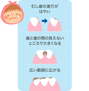 むし歯の進行がはやい／歯と歯の間の見えないところで大きくなる／広い範囲に広がる