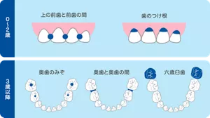 乳歯のむし歯のなりやすいところは0～2歳までは上の前歯と前歯の間、歯のつけ根です。3歳以降は奥歯のみぞや奥歯と奥歯の間、一番奥の六歳臼歯です。