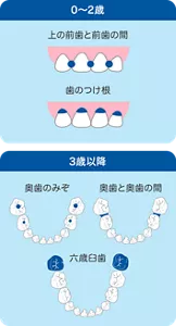 乳歯のむし歯のなりやすいところは0～2歳までは上の前歯と前歯の間、歯のつけ根です。3歳以降は奥歯のみぞや奥歯と奥歯の間、一番奥の六歳臼歯です。