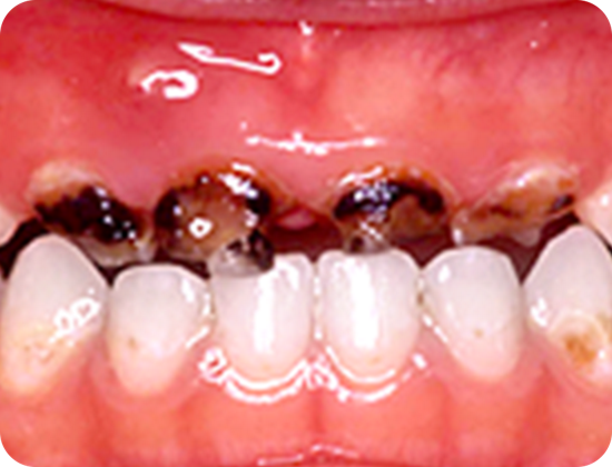 1 乳歯の むし歯の特徴 乳歯期の歯みがきq A 0 6歳 オーラルケア情報 クリアクリーン 花王株式会社