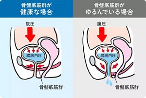 骨盤底筋群が健康な場合は、腹圧がかかり膀胱内圧がかかっても、骨盤底筋群が収縮することで尿もれしません。骨盤底筋群がゆるんでいる場合は、腹圧がかかり膀胱内圧がかかると、骨盤底筋群が収縮するものの締める力が弱く、尿もれしてしまいます。