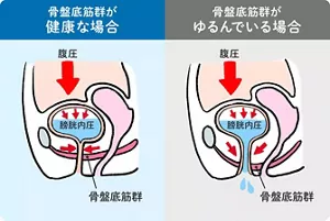 骨盤底筋群が健康な場合は、腹圧がかかり膀胱内圧がかかっても、骨盤底筋群が収縮することで尿もれしません。骨盤底筋群がゆるんでいる場合は、腹圧がかかり膀胱内圧がかかると、骨盤底筋群が収縮するものの締める力が弱く、尿もれしてしまいます。