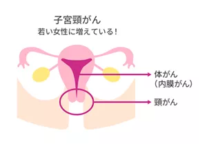 子宮がんが発生する場所のイメージ。 頸がんは子宮の入口に、体がんは子宮の内部に発生する。