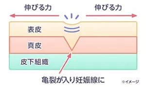 妊娠線ができるメカニズム　※イメージ