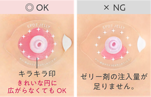 OK：ゼリー剤がシールのキラキラ印までたっぷり注入された状態　NG：ゼリー剤の注入量が足りず、キラキラ印まで満たされていない状態
