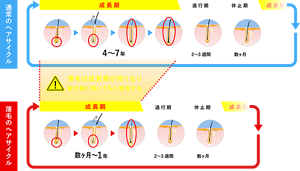 （1）通常のヘアサイクル・・・成長期4～7年、退行期2～3週間、休止期数ヶ月（2）薄毛のヘアサイクル・・・成長期数ヶ月～1年、退行期2～3週間、休止期数ヶ月　薄毛は成長期が短くなり髪が細く短いうちに脱毛する。