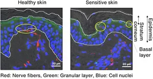 Figure 1. In the healthy skin, the tight junctions have kept the nerve fibers to well below the stratum corneum, but in the sensitive skin, the nerve fibers have extended to immediately below the stratum corneum.