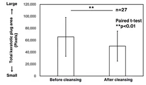 Graph comparing the total keratotic plug area before and after cleansing with a facial cleanser incorporating the new technology.
