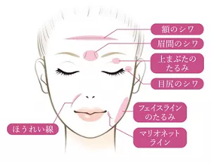 ほうれい線やそれ以外に使用可能な範囲がわかるイラスト