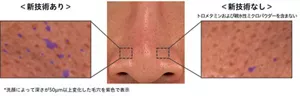 角栓を含む毛穴形状の洗顔前後での変化を、新技術ありで比較した著効例の写真