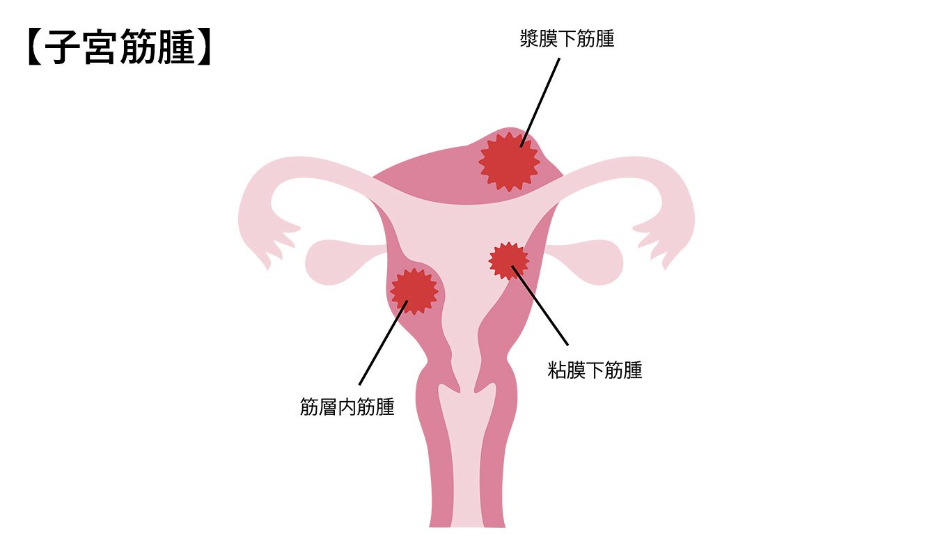 子宮 筋腫 頻 尿