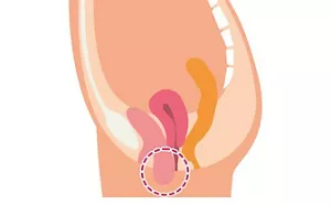 膀胱瘤を表したイラスト